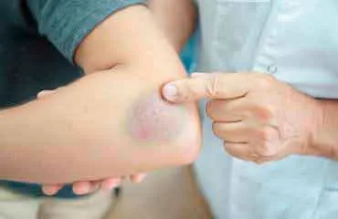 foot detox patches for bruises and sprains